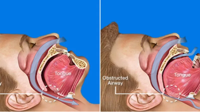 Chế độ ăn uống lành mạnh tốt cho người mắc hội chứng ngừng thở khi ngủ